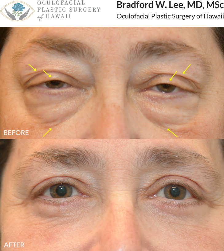 This patient in her 50s was bothered by heavy upper eyelids that were uncomfortable and affecting her vision. She was also bothered by the puffiness under her eyes, making her appear aged and tired. She underwent an upper and lower (quad) blepharoplasty with a ptosis repair to restore her vision and give her a brighter and more youthful rejuvenation.