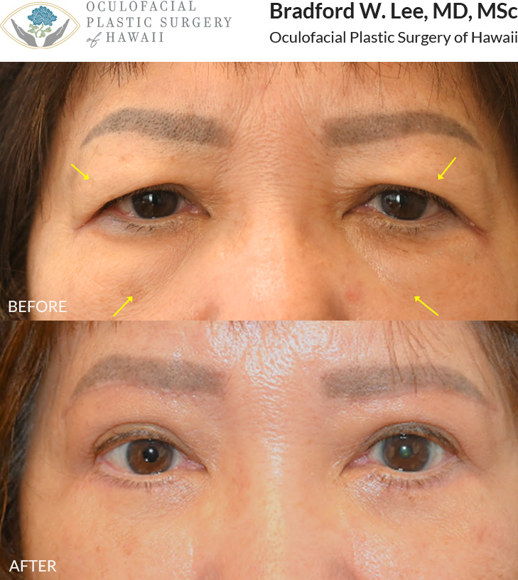 This 70+ year-old patient was bothered by heavy upper eyelids that were affecting her vision and ability to carryout daily acitivities such as reading and driving. She was also bothered by the puffy appearance of her under eyes. She underwent an upper and lower (quad) blepharoplasty.