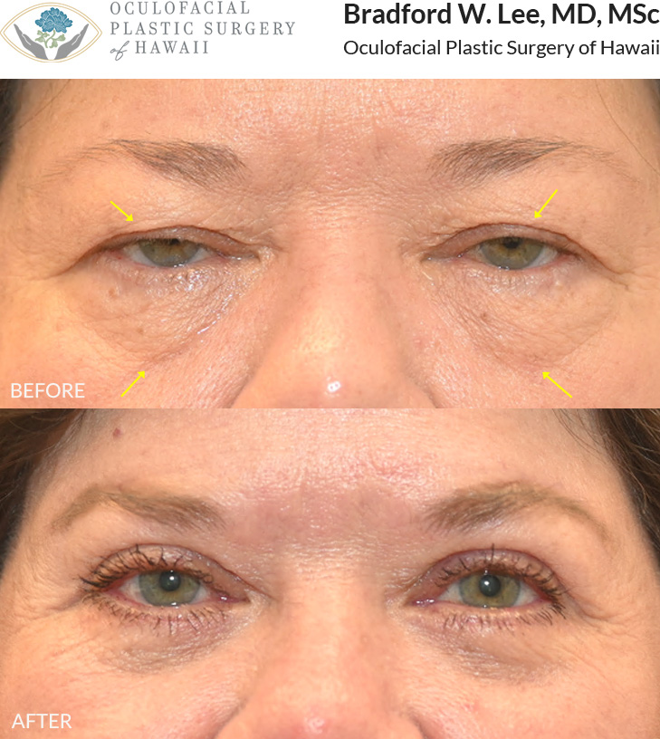 This 60+ year-old patient was bothered by heavy upper eyelids that were affecting her vision and giving her a tired and aged appearance. She was also bothered by the puffiness under her eyes. She underwent an upper and lower (quad) blepharoplasty with a brow lift to lift the upper eyelids and restore the youthful contours of her eyes.