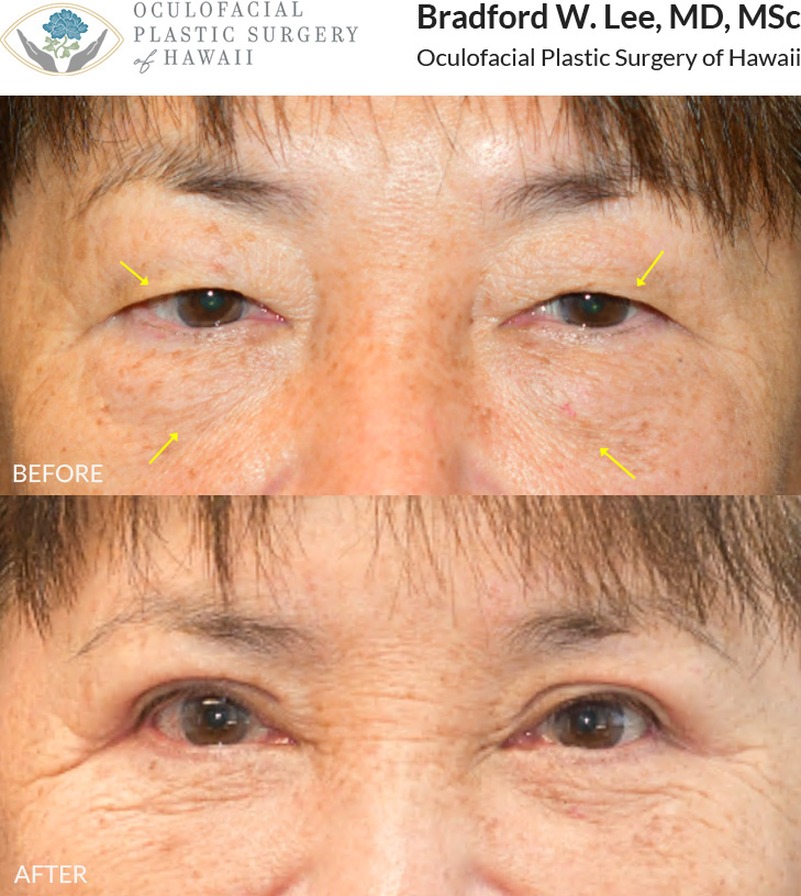 This patient in her 60s was bothered by upper eyelid hooding that interfered with her vision, as well as puffiness in the undereye region. She underwent an upper and lower (quad) blepharoplasty to remove excess skin and fat and restore her vision.
