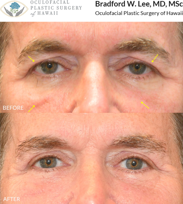 This patient in his 50s was bothered by heavy upper eyelids affecting his vision and puffiness beneath the eyes. He underwent an upper and lower blepharoplasty with ptosis repair to lift the eyelids, remove excess skin and fat, and achieve a brighter, refreshed, and refined appearance.