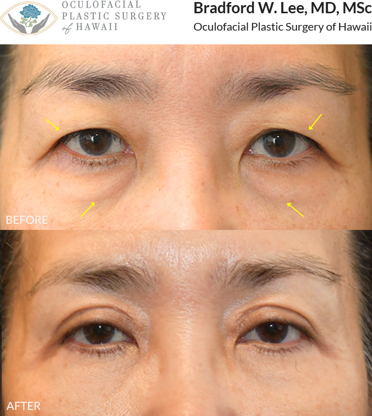 This 50+ year-old patient was bothered by excess skin on her upper eyelids weighing on her eyelashes, as well as puffiness in the under-eye area. She underwent an upper and lower (quad) blepharoplasty to address these concerns, resulting in a more defined eyelid crease and a smoother under-eye contour.