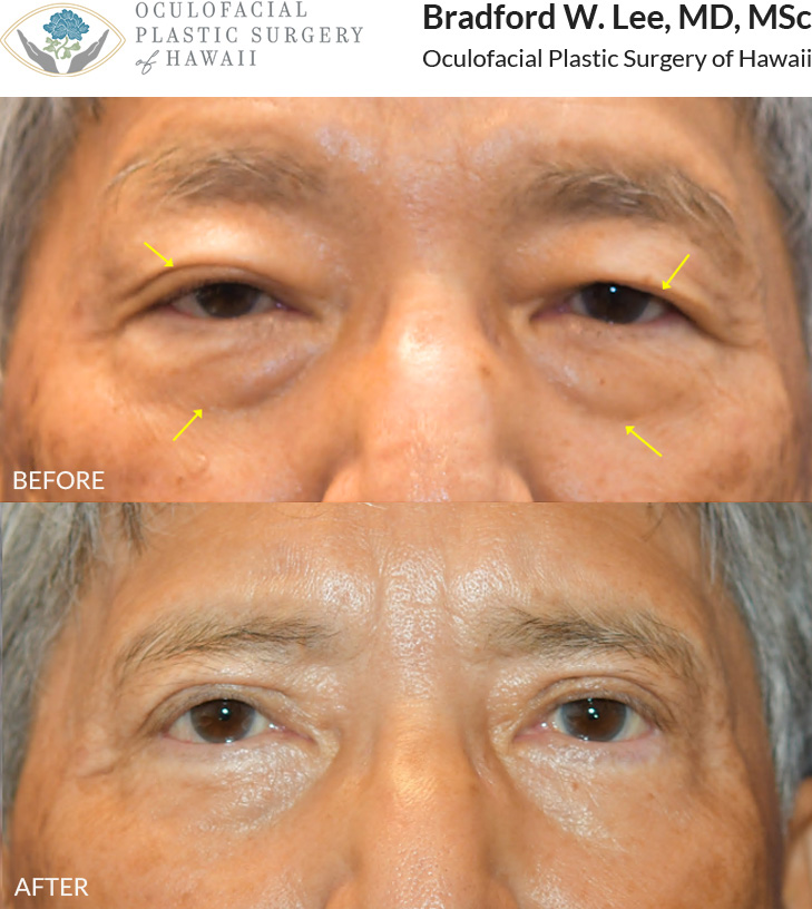 This 70+ year-old patient was concerned about drooping upper eyelids and puffiness beneath his eyes. He underwent upper and lower (quad) blepharoplasty to remove excess skin and fat, along with a right ptosis repair to further elevate the right upper eyelid for improved symmetry and a more refreshed appearance.