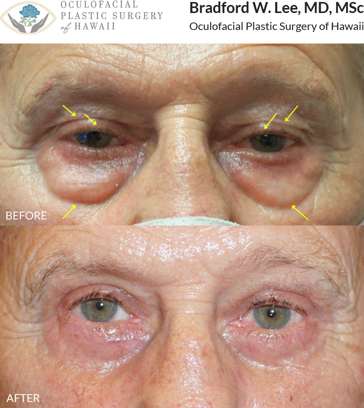 This patient in his 70s was bothered by heavy, drooping upper eyelids that made it difficult to see, as well as puffy under-eye bags. He underwent an upper and lower (quad) blepharoplasty to remove excess skin and fat, resulting in a more open, refreshed, and rejuvenated periocular appearance.