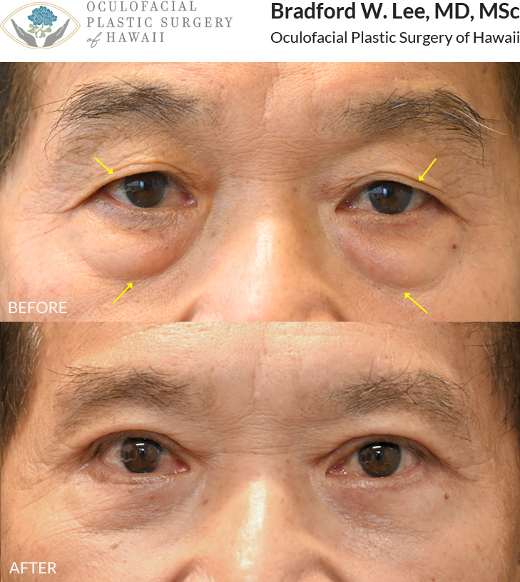 This patient in his 70s was bothered by drooping upper eyelids and the puffiness of his undereyes. He underwent an upper and lower (quad) blepharoplasty to remove any excess skin and fat amd restore the natural contours of his eyes.