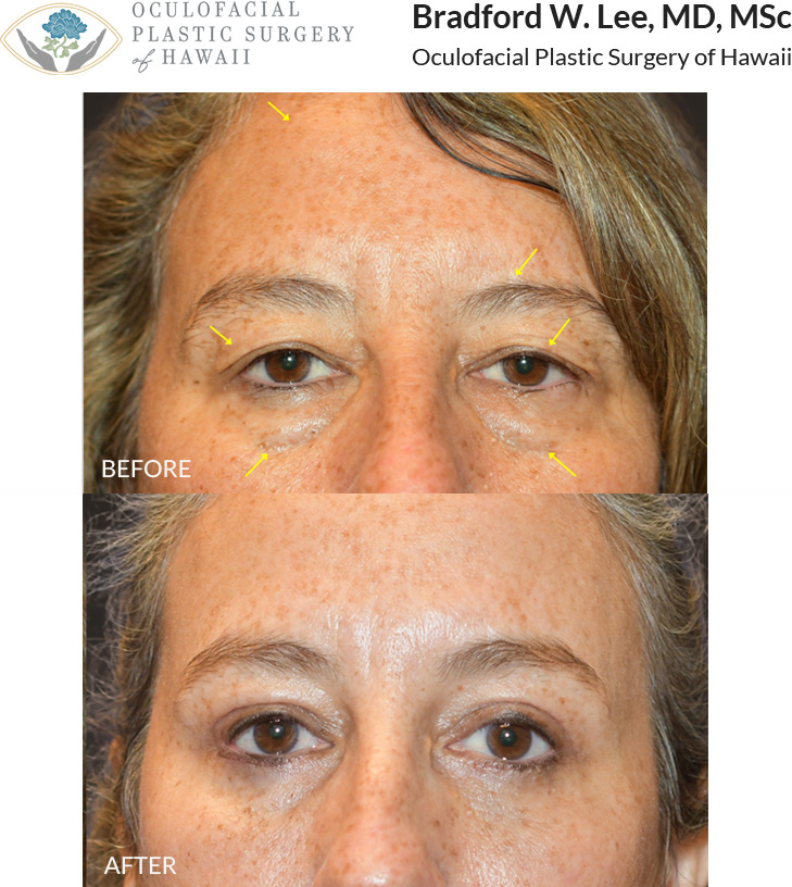 This patient in her mid to late 50s was bothered by heaviness of her upper eyelids and felt she had to manually lift them in order to see more clearly. She was also bothered by the appearance of her undereye 