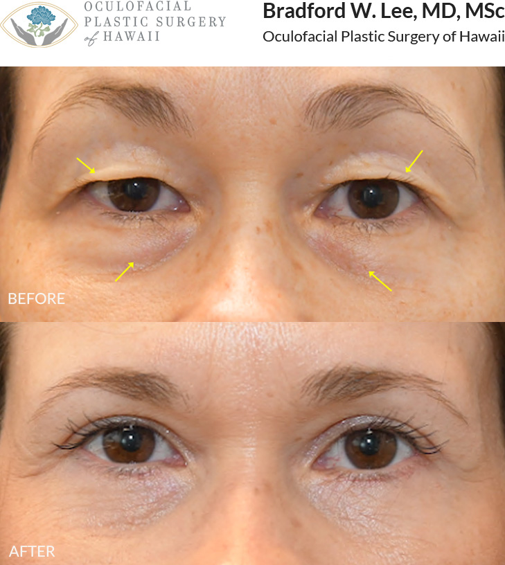 This patient in her mid 40s experienced upper eyelid drooping that interfered with everyday activities, including reading and driving. She was also troubled by under-eye puffiness that gave her a fatigued appearance. She underwent an upper and lower (quad) blepharoplasty to address excess skin and fat of the upper and lower eyelids, rejuvenating the periocular area and giving her a more youthful glow.