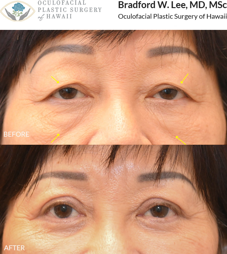 This patient in her 70s was concerned about drooping upper eyelids affecting her vision and the appearance of under-eye 