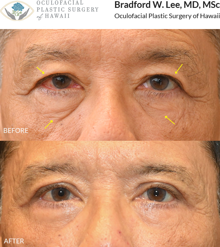 This patient in his mid to late 60s was bothered by heavy upper eyelids that affected his vision, as well as the appearance of under-eye bags. He underwent an upper and lower (quad) blepharoplasty to remove excess skin and fat from both the upper and lower eyelids, restoring his visual field and creating a brighter, smoother, and more balanced eyelid contour.