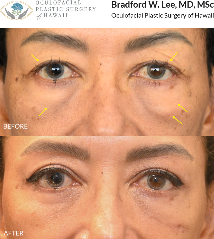 This 50+ year-old patient was bothered by heavy upper eyelids and puffiness beneath her eyes. She underwent an upper and lower (quad) blepharoplasty with a left direct festoon excision to remove excess skin and fat from both the upper and lower eyelids, while smoothing the upper cheek contour for a more refreshed appearance.