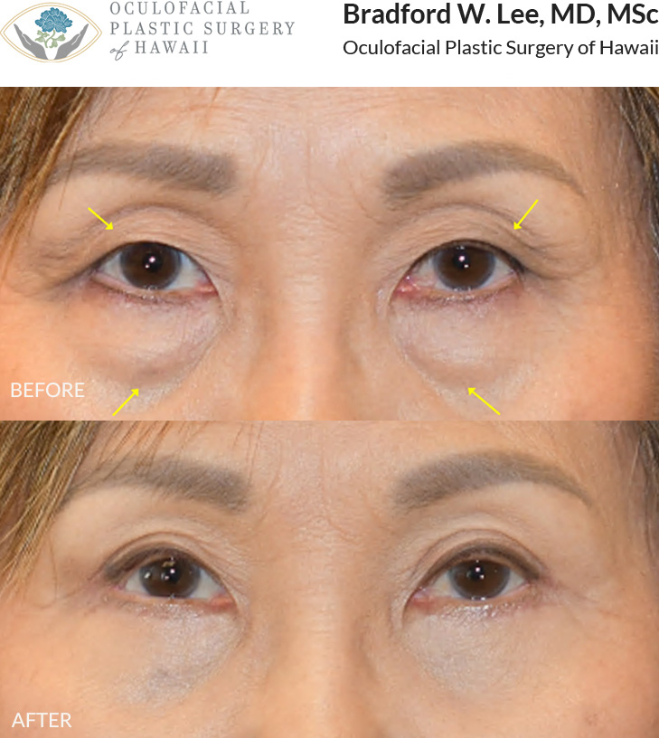 The patient in her early 70s was bothered by heaviness of the upper eyelids and puffiness of the lower eyelids. She underwent upper and lower (quad) blepharoplasty to smooth the under-eye region and improve her visual field, resulting in a more youthful and refreshed appearance.