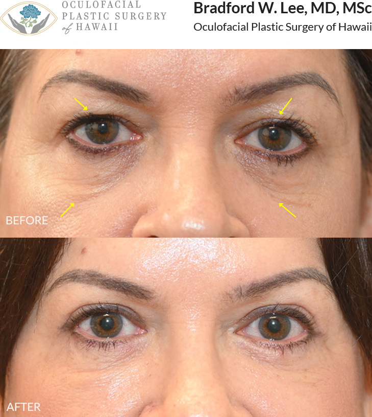 This patient in her 60s was concerned about heavy upper eyelids that rested on her lashes and hollowing beneath the eyes. She underwent an upper and lower (quad) blepharoplasty to improve the contours of the upper and lower eyelids and create a brighter, more rejuvenated appearance.