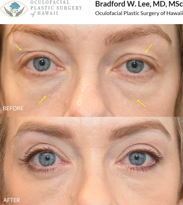 This 40+ year-old patient was concerned about upper eyelid asymmetry and the appearance of under-eye 