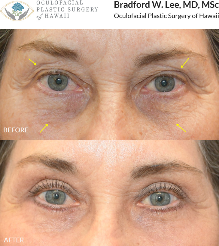 This patient in her mid to late 60s was bothered by heavy upper eyelids caused by excess skin, as well as the appearance of under-eye hollows and dark circles. She underwent an upper and lower (quad) blepharoplasty to rejuvenate the eye area and restore a brighter, more refreshed appearance.