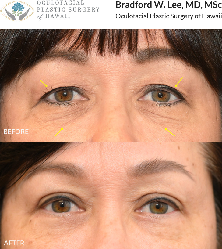 This 60+ year-old patient was bothered by excess skin on both the upper and lower eyelids that made her eyes appear tired and aged. She underwent an upper and lower (quad) blepharoplasty to remove excess skin and fat, creating a more open, refreshed, and youthful appearance.