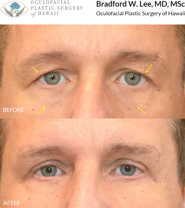 This patient in his 50s was bothered by heavy upper eyelids that affected his vision during everyday activities, including reading and driving. He also wanted to improve the appearance of the under-eye area. He underwent an upper and lower (quad) blepharoplasty to improve his visual field while rejuvenating the appearance of his eyes.