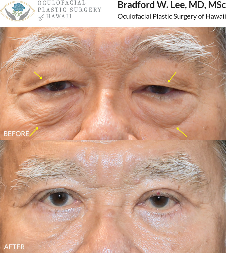 This patient in his 70s was concerned about heavy upper eyelids that interfered with his vision and puffiness of the lower eyelids. He underwent an upper and lower (quad) blepharoplasty to remove excess skin and fat, giving him a smoother and brighter look.