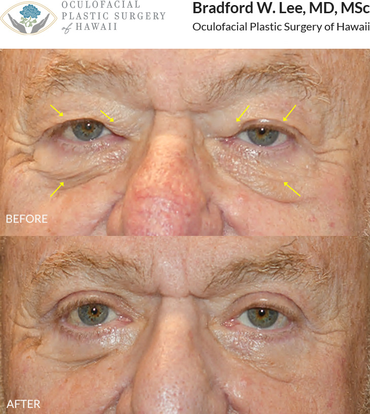 This patient in his 70s was bothered by heavy upper eyelids and excess on the lower eyelids. He underwent an upper and lower (quad) blepharoplasty to remove excess skin and fat from his upper eyelids and under-eye region for a natural enhancment.