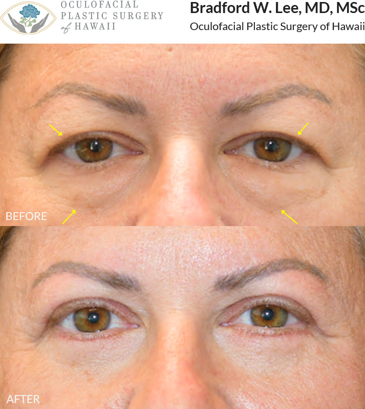 This 50+ year-old patient was bothered by excess skin on her upper eyelids, which made them feel heavy and caused them to rest on her lashes. She was also bothered by puffiness under her eyes. She underwent an upper and lower (quad) blepharoplasty, achieving a brighter and more youthful look. **Residual swelling will continue to resolve over time.