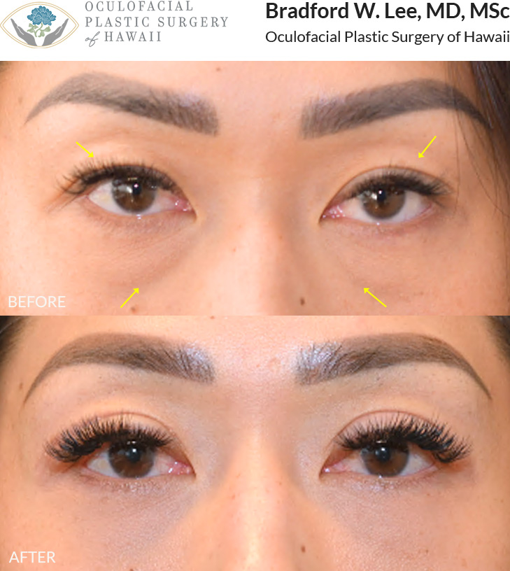 This 30+ year-old patient was bothered by eyelid asymmetry and wanted to enhance the appearance of her double eyelid crease. She was also bothered by hollowing under her eyes. She underwent an upper and lower (quad) blepharoplasty to remove excess skin, define the eyelid crease, and smooth the under-eye area.