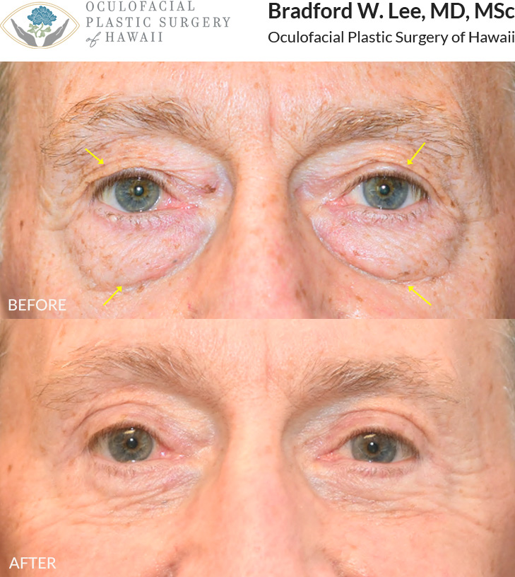 This patient in his 70s was bothered by excess skin on his upper eyelids and puffiness of the lower eyelids. He underwent an upper and lower (quad) blepharoplasty to address these concerns, revealing a rejuvenated, youthful appearance that restores natural eye contour and reduces signs of aging.