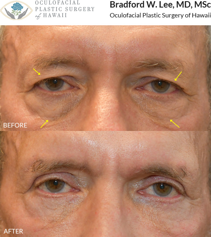 This patient in his 60s was bothered by excess skin on his upper eyelids and under-eye 