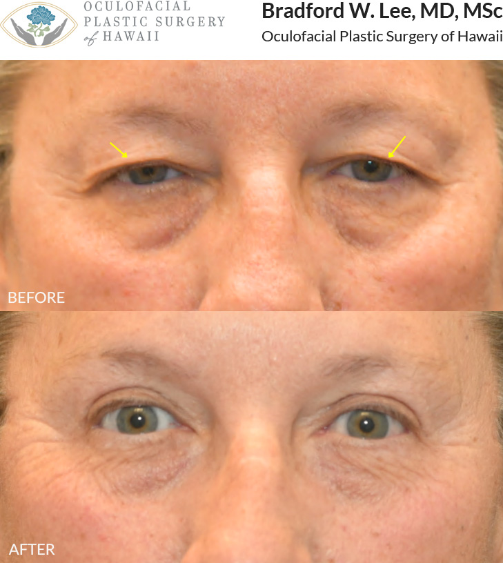 This 50+ year-old patient was bothered by drooping upper eyelids that were affecting her vision and contributing to a more tired appearance. She underwent an upper blepharoplasty to remove excess skin and fat, improving her visual field while creating a more refreshed and youthful glow.