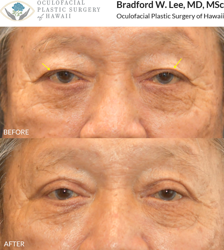 This 70+ year-old patient was experiencing drooping upper eyelids that were affecting everyday activities like reading and driving. He underwent an upper blepharoplasty to remove the excess skin and fat that were obstructing his vision, resulting in improved visual function and a more refreshed appearance.