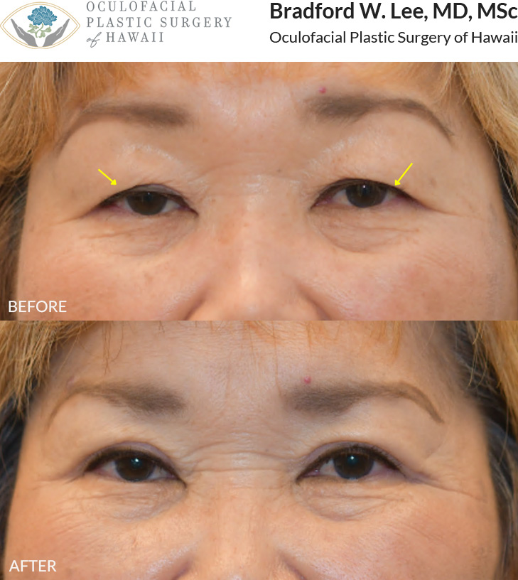 This 70+ year-old patient was bothered by heavy, drooping upper eyelids that made her appear tired and aged. She underwent an upper blepharoplasty to remove the excess skin and fat weighing down her eyelids, resulting in a brighter, more refreshed appearance.