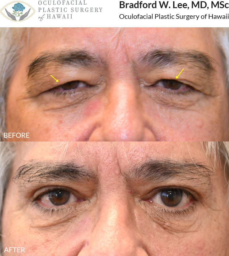 This 70+ year-old patient was bothered by the heaviness and drooping of his upper eyelids, which were affecting daily activities such as reading and driving. He underwent an upper blepharoplasty to remove the excess skin and fat weighing down his eyelids, as well as a direct brow lift to further elevate the brows and restore his visual field. The result was improved vision and a brighter, more refreshed appearance.