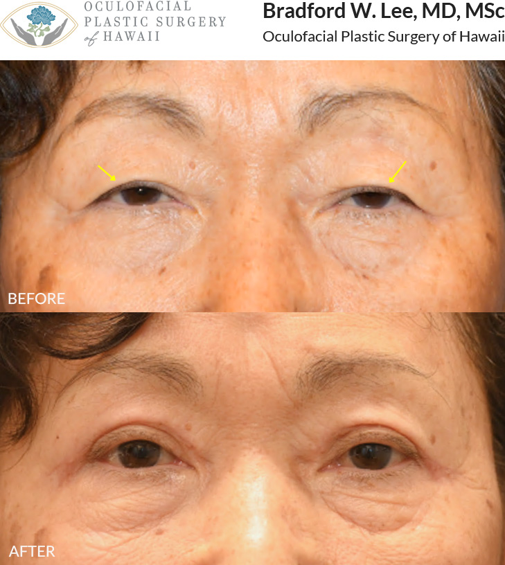 This 70+ year-old patient was bothered by drooping upper eyelids that were affecting her vision and required her to manually lift her eyelids to see better. She underwent an upper blepharoplasty to remove the excess skin and fat weighing down her eyelids, improving her vision and daily comfort.