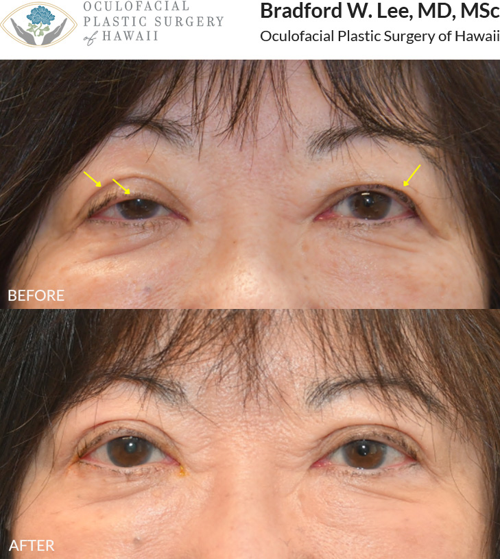 This 70+ year-old patient was bothered by drooping upper eyelids that were limiting her vision and making daily activities like reading and driving more difficult. She also often found herself raising her brows to see more clearly. An upper blepharoplasty was performed to remove excess skin and fat, with a right ptosis repair to further lift the right eyelid and improve her visual field. **Mild residual swelling will continue to improve over the next few weeks