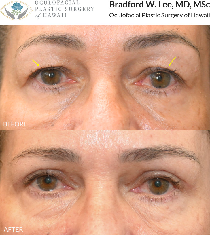 This 60+ year-old patient was bothered by drooping upper eyelids and wanted to restore her natural double eyelid. She underwent an upper blepharoplasty to remove any excess skin and fat, creating a more defined and balanced eyelid contour.
