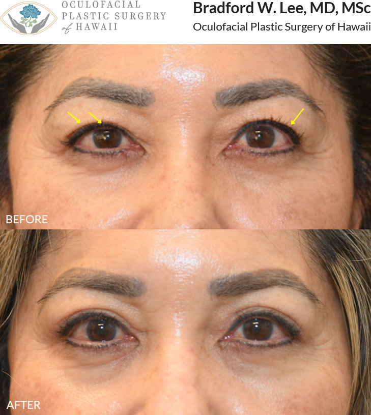 This 60+ year-old patient was bothered by drooping of her right upper eyelid and excess skin of the upper eyelids. She underwent an upper blepharoplasty and right ptosis repair to improve eyelid symmetry and create a more even appearance.