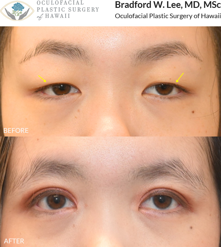 This 20+ year-old patient was looking to achieve a more defined double eyelid crease. She underwent an Asian upper blepharoplasty to create a natural-looking eyelid fold and enhance the appearance of her upper eyelids.