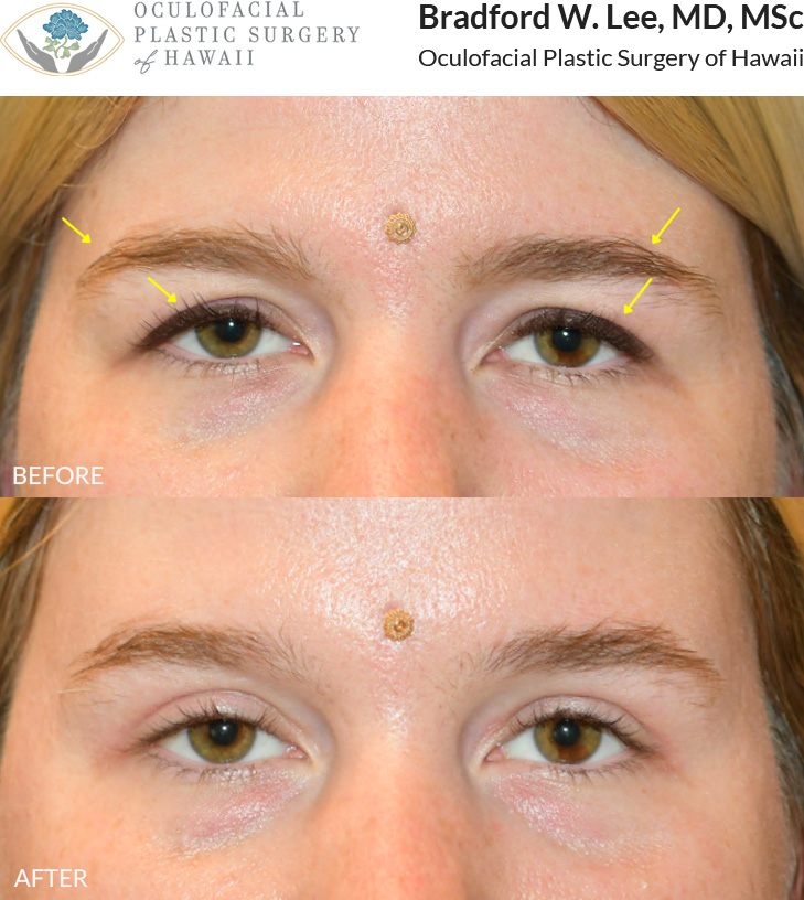 This 30+ year-old patient was bothered by the drooping of her upper eyelids, forehead, and brows. She underwent an upper blepharoplasty to remove excess skin ad fat, with a trichophytic browlift to lift her brows and forehead.