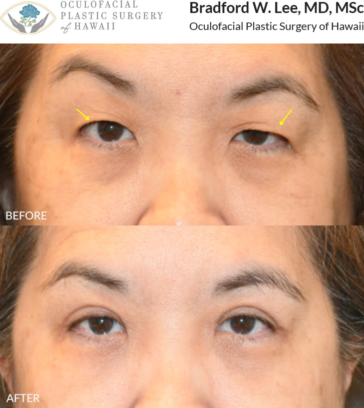 This 50+ year-old patient was bothered by heavy, drooping upper eyelids that were affecting her vision and daily activities such as reading, driving, and watching tv. She often found herself needing to lift her eyelids to see better. She underwent an upper blepharoplasty to remove the excess skin weighing down her eyelids, improving her field of vision and ability to perform daily activities comfortably.