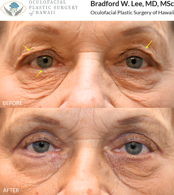 This patient in her mid to late 70s was bothered by heavy upper eyelids and irritation caused by her right lower eyelid turning inward. She underwent an upper blepharoplasty to remove the excess skin weighing down her upper eyelids, along with an entropion repair to correct the lower eyelid position and relieve her discomfort.