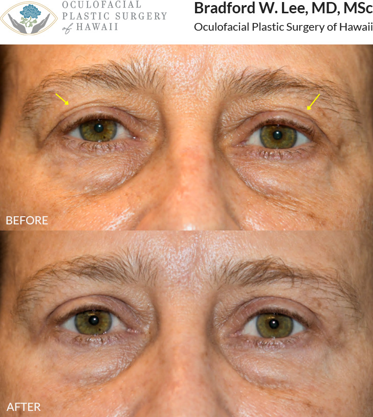 This patient in her mid to late 50s was bothered by the heaviness of her upper eyelids. She underwent an upper blepharoplasty to remove excess skin and rejuvenate the appearance of her eyes.