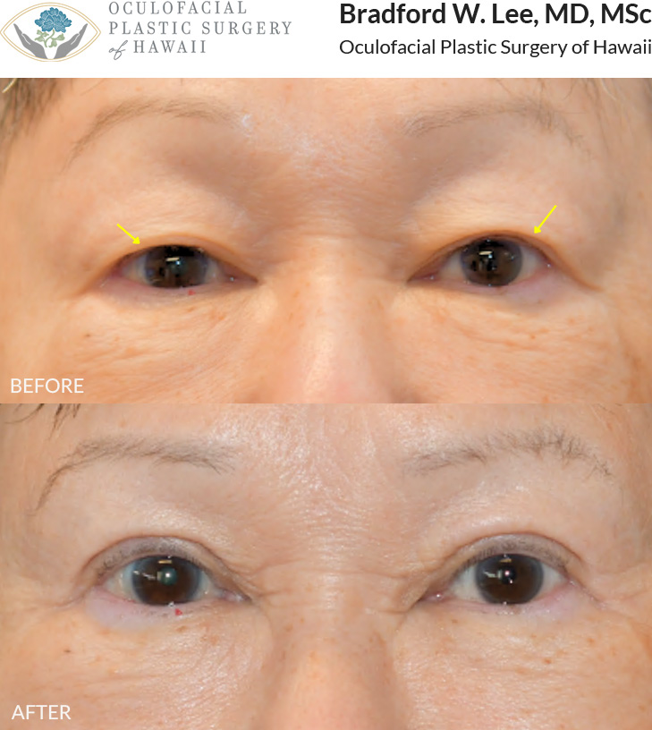 This 70+ year-old patient was bothered by drooping upper eyelids and desired a more defined, natural-looking eyelid crease. She underwent an upper blepharoplasty to remove excess skin and fat while creating a natural eyelid fold and enhancing the overall contour of her eyes.