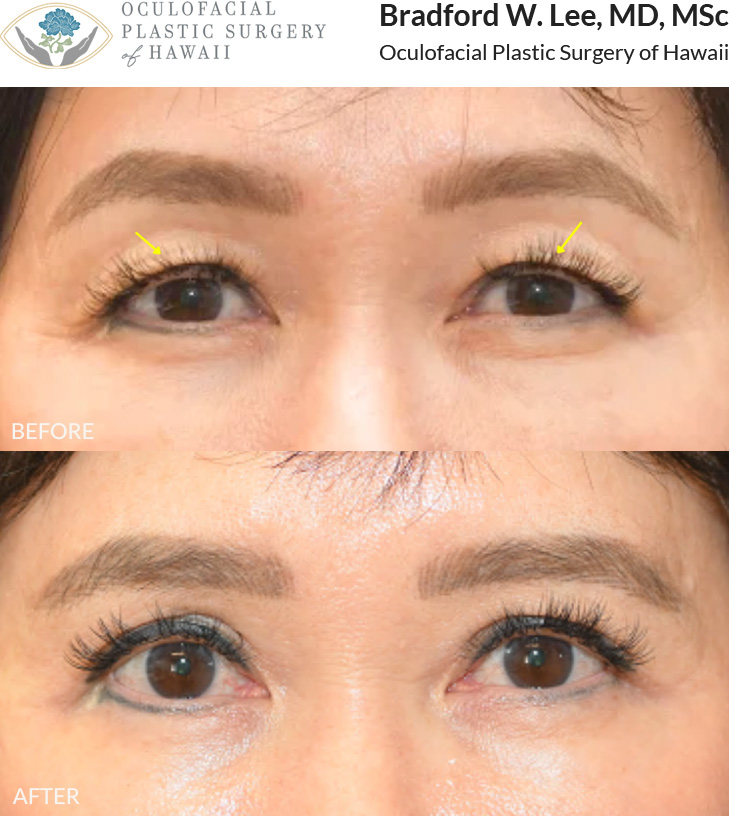 This 60+ year-old patient was bothered by drooping upper eyelids that were resting on her lashes and affecting daily activities such as reading and driving. She underwent an upper blepharoplasty to remove excess skin and fat, improving her vision and restoring a naturally rejuvenated appearance.