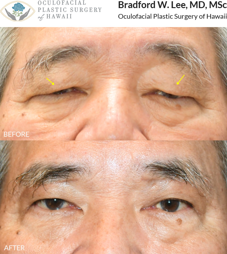 This 70+ year-old patient was bothered by heavy, drooping upper eyelids that were obstructing his vision and making daily activities such as reading and driving more difficult. He underwent a sub-brow upper blepharoplasty to remove excess skin and fat from the upper eyelids while preserving his natural eyelid anatomy and avoiding the creation of an eyelid crease. The procedure improved his vision and overall quality of life.
