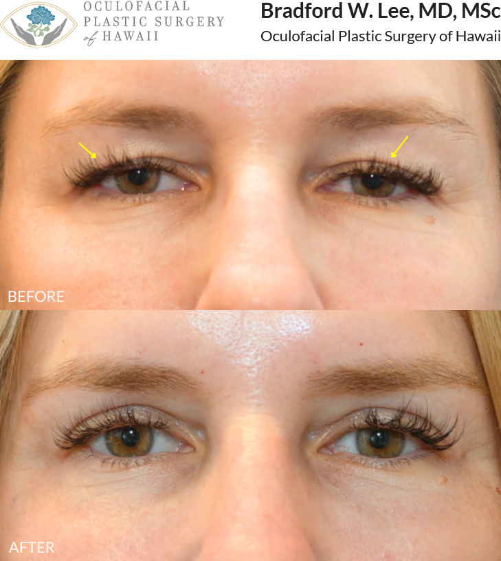 This 40+ year-old patient was bothered by drooping upper eyelids that gave her a tired, more aged appearance. She underwent an upper blepharoplasty to remove the excess skin weighing down her eyelids, restoring a naturally rejuvenated appearance.