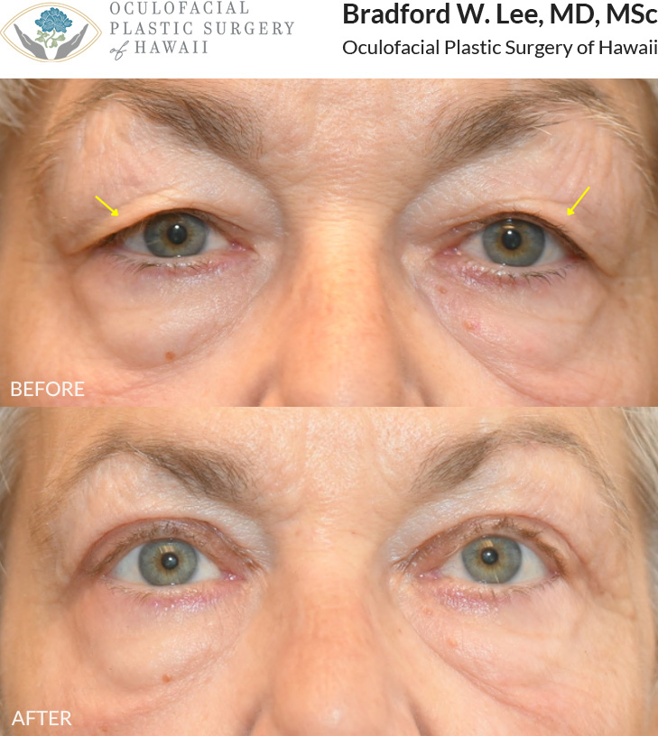 This patient in her 60s was bothered by drooping upper eyelids that made it difficult for her to see. She underwent an upper blepharoplasty to remove excess skin and fat from the upper eyelids, improving her vision and giving her a more youthful glow.