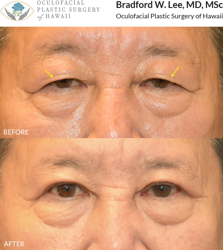 This 60+ year-old patient was bothered by drooping upper eyelids that were affecting his vision and contributing to a tired appearance. He underwent an upper blepharoplasty to remove excess skin and fat from the upper eyelids, improving his vision and restoring a more natural upper eyelid contour.