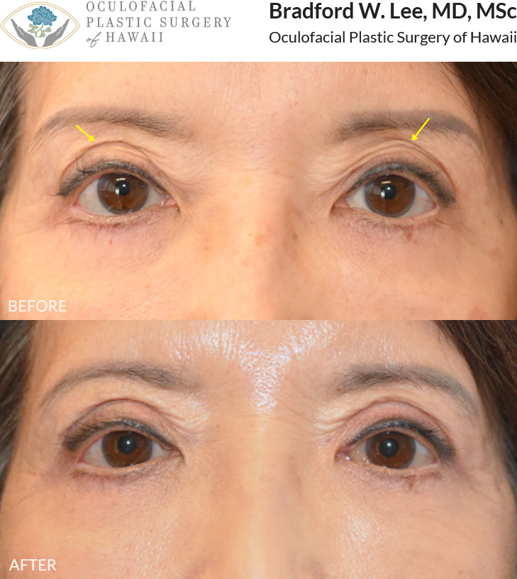 This patient in her 60s had undergone upper eyelid surgery elsewhere and was concerned about asymmetry and multiple eyelid creases. She underwent an upper blepharoplasty revision to restore balance and create a smoother, more natural upper eyelid contour.