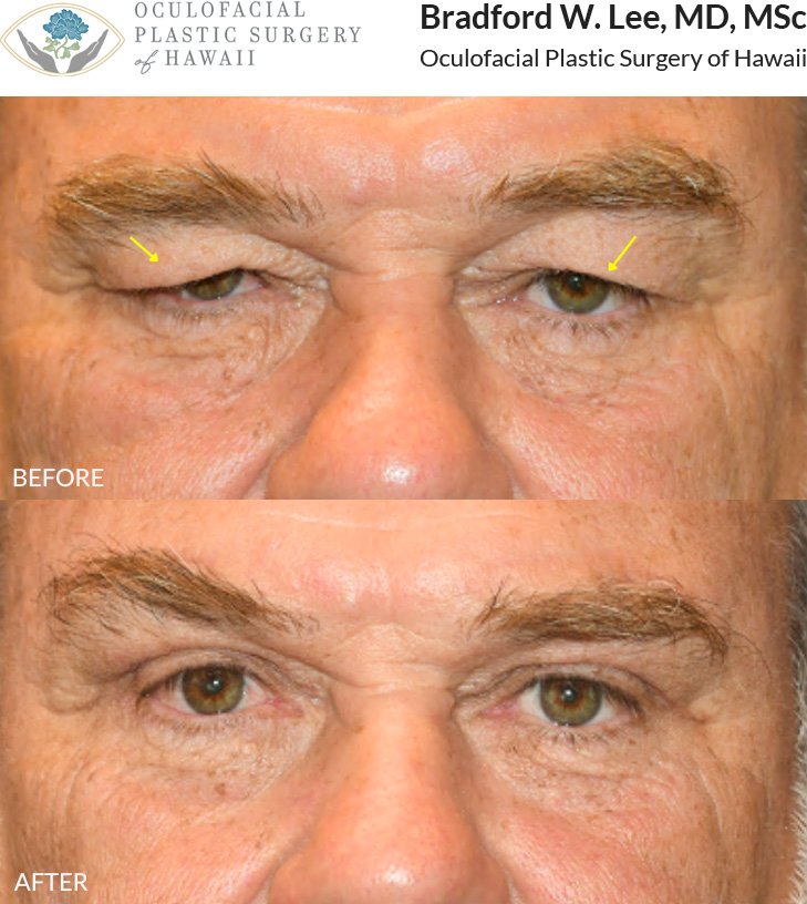 This 60+ year-old patient was bothered by heavy, drooping upper eyelids that were affecting his vision. He underwent an upper blepharoplasty to remove excess skin and fat, along with a direct brow lift to further elevate the brows and open the eyes. Together, these procedures improved his visual field while creating a more refreshed, natural appearance.