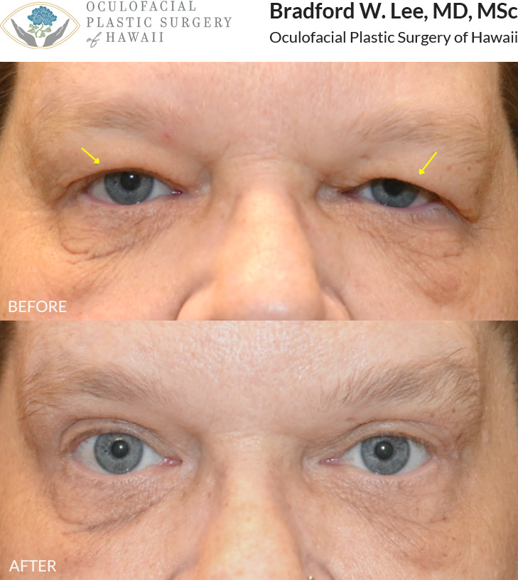 This patient in her 50s was bothered by drooping upper eyelids that interfered with daily activities and made her eyes appear tired and aged. She underwent an upper blepharoplasty to remove excess skin and fat, opening the eyes and creating a brighter, rejuvenated appearance.