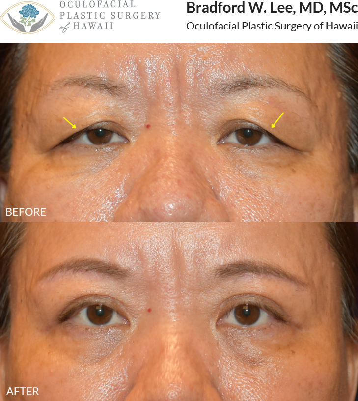 This patient in her mid to late 40s was bothered by heavy upper eyelids that were resting on her lashes and affecting her vision. She underwent a sub-brow upper blepharoplasty to remove excess skin and fat from the upper eyelids while maintaining her natural eyelid crease, improving her vision and creating a more refreshed, youthful appearance.