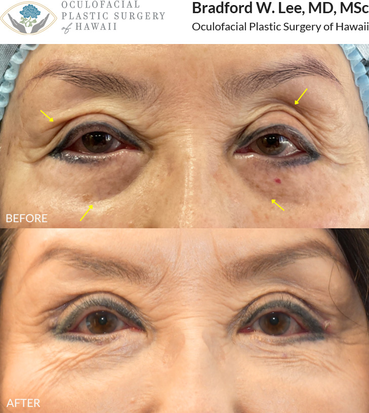 This 70+ year-old patient had previously undergone eyelid surgery elsewhere and was bothered by upper eyelid asymmetry, multiple upper eyelid creases, and hollowing around the eyes. She was also unable to fully close her eyes, leading to dry eye symptoms and ongoing discomfort. She underwent a revision upper blepharoplasty with canthoplasty and lower eyelid fat transfer to restore a more natural eyelid contour, address under-eye hollowing, and improve eyelid position and closure.